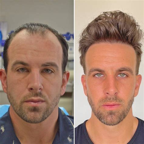 hair transplants st louis mo|2024 TOP 10 Best Hair Transplant Clinics in the USA + Cost .